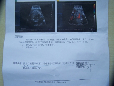 超声心电图报告单